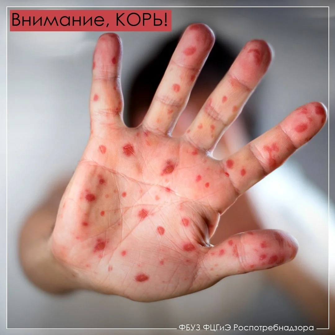 Внимание КОРЬ